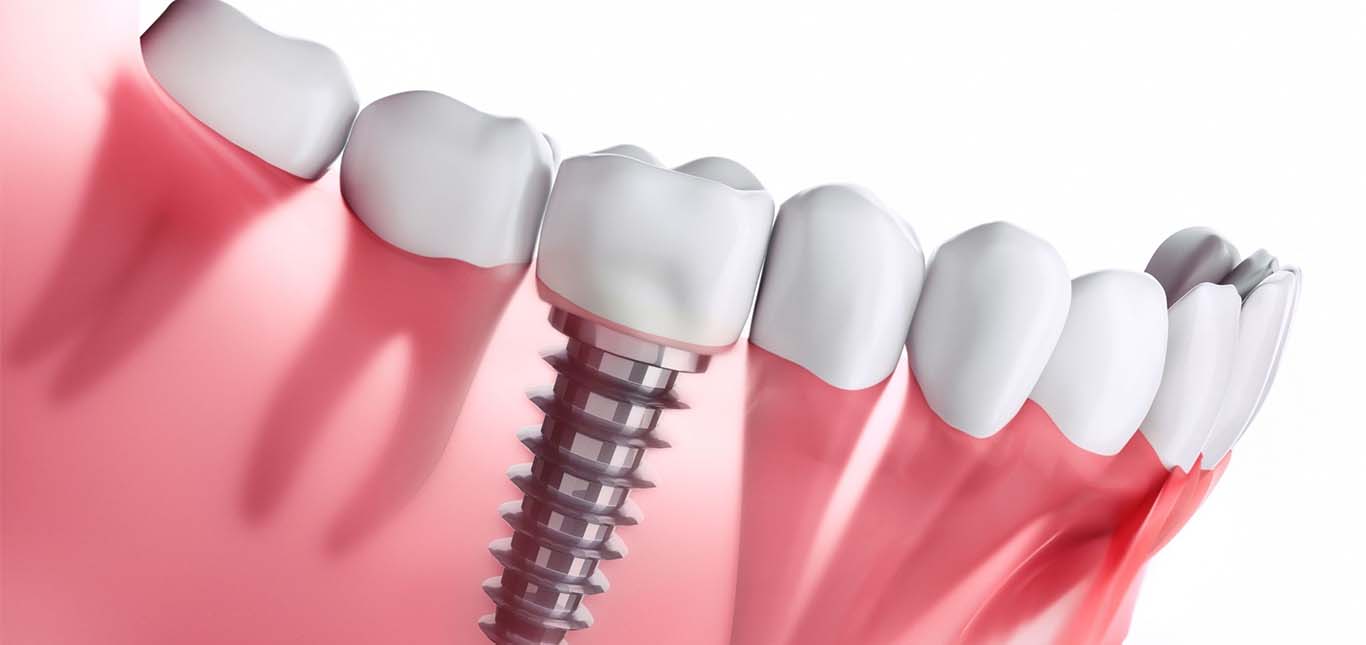 Dental implants in Mira road