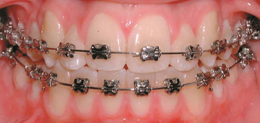 Braces treatment in Mira road