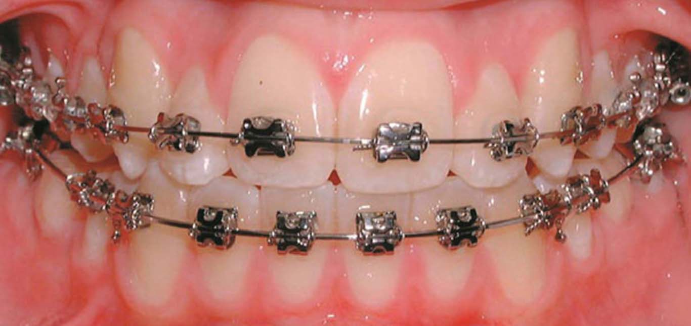 Orthodontic treatment in Mira road ( braces treatment in Mira road )