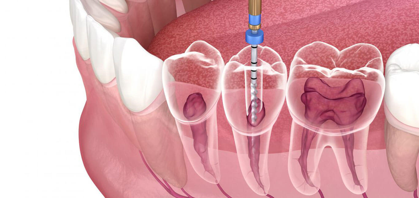 Root canal treatment in Mira road