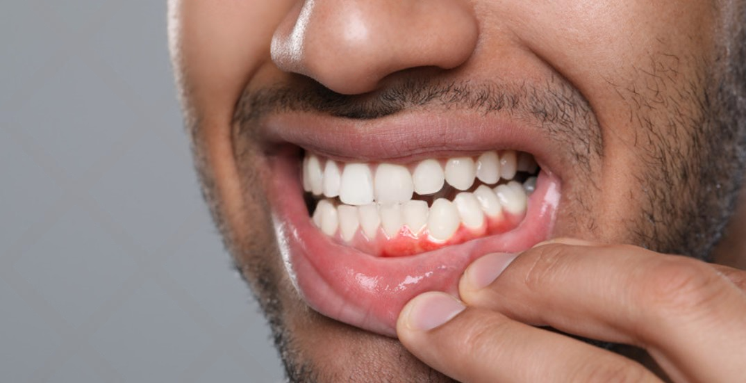 Gum Disease (Gingivitis & Periodontitis)