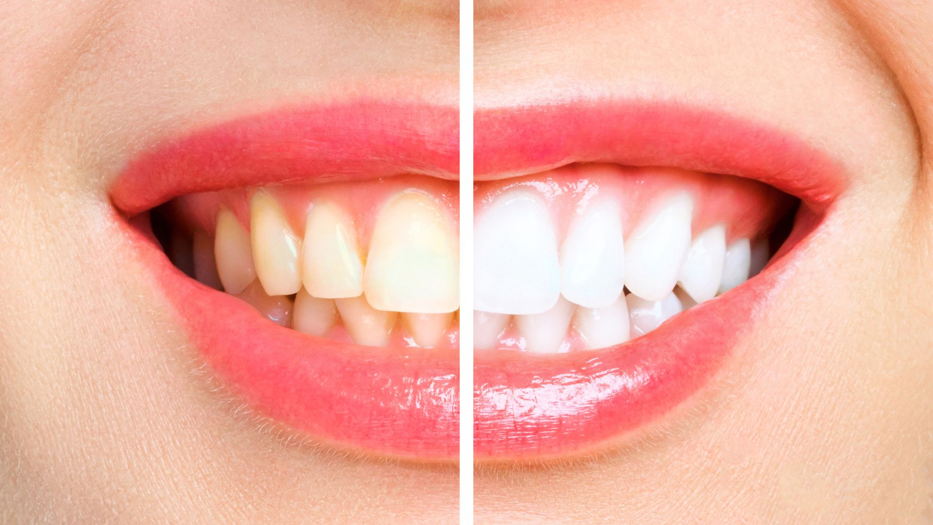 Teeth Whitening