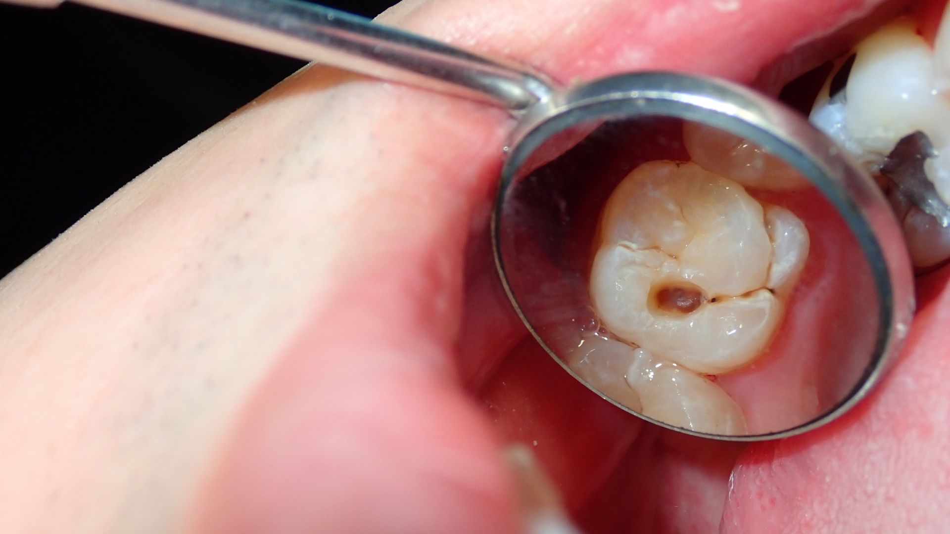 Alternatives to Dental Implants