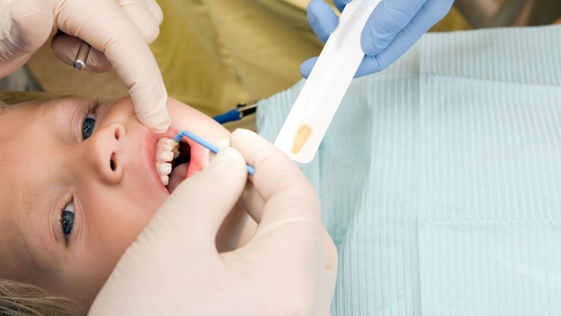 Benefits of Professional Fluoride