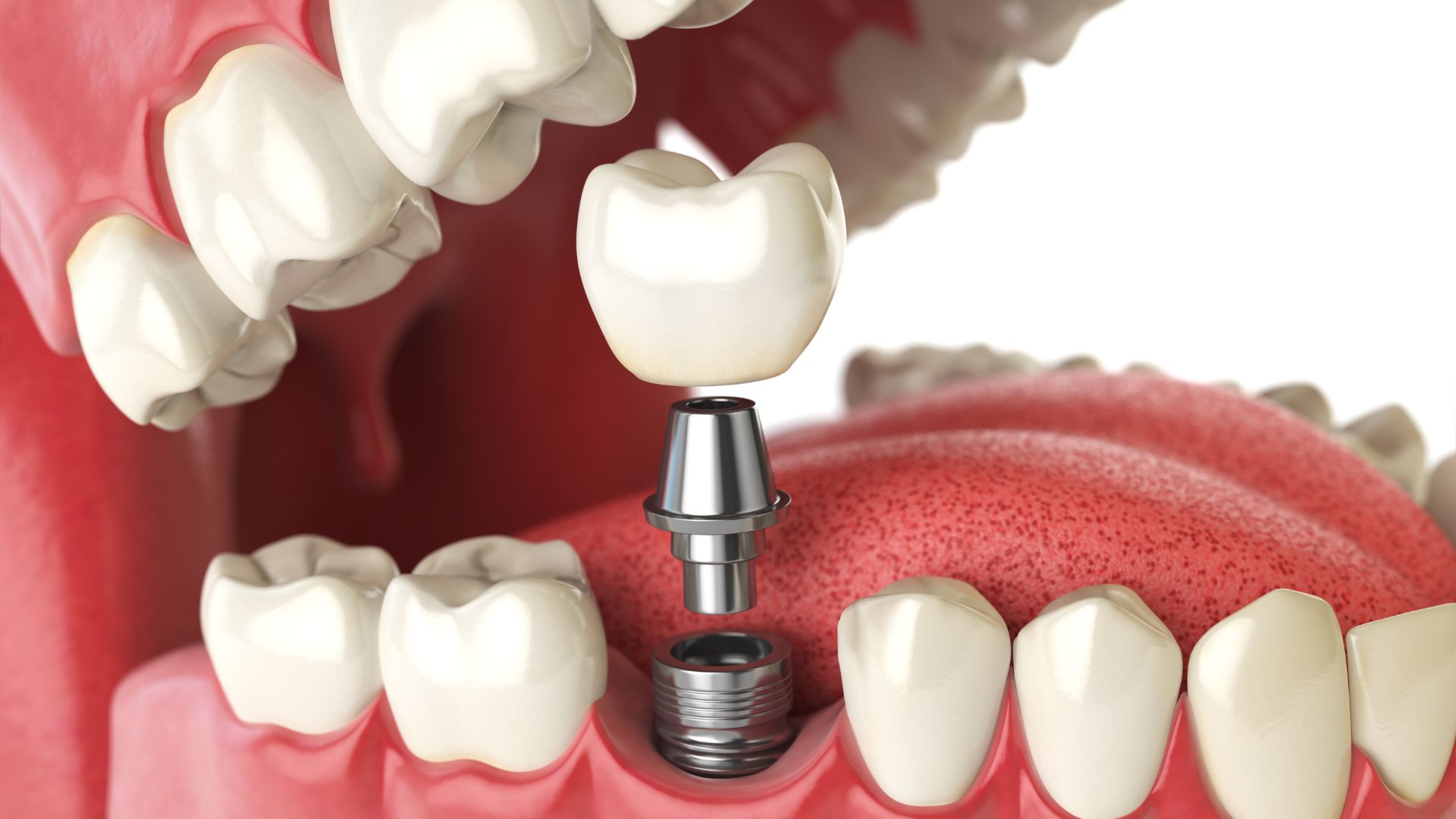 Implant Failure