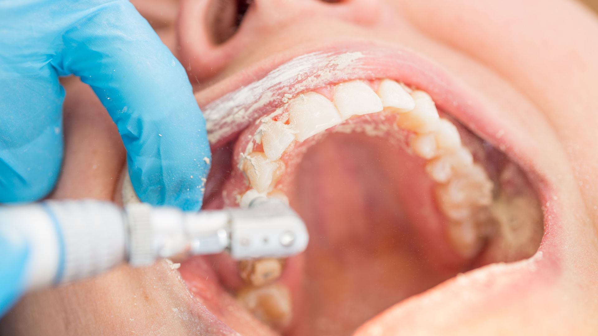 Step-by-Step: What Happens During Teeth Cleaning?