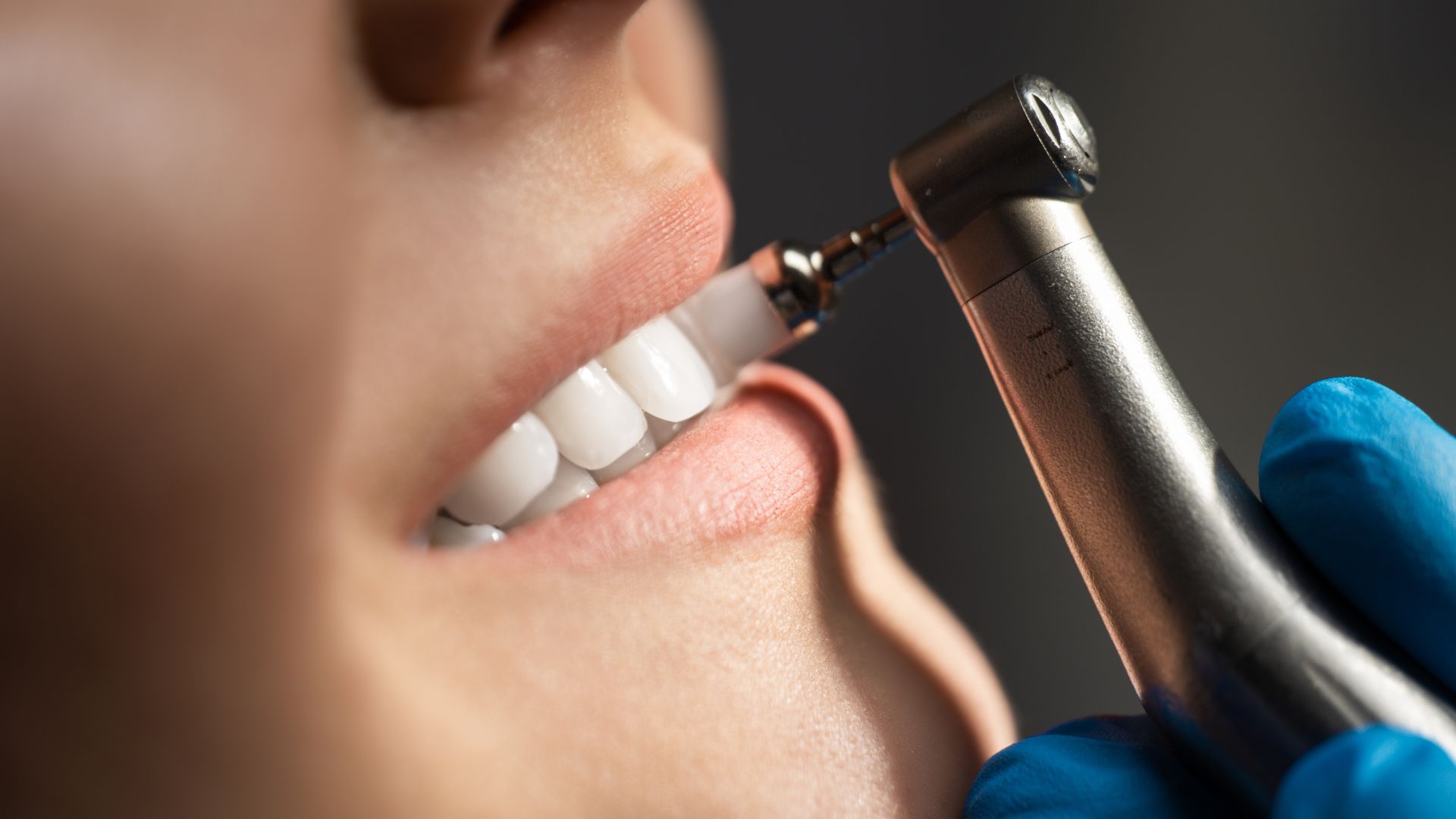 Teeth Cleaning