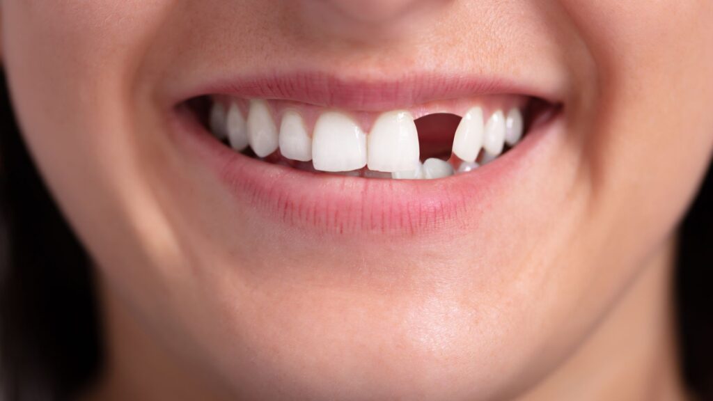 Life of Your Tooth Replacement