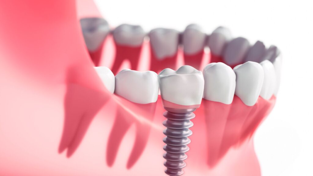 Fascinating History of Dental Implants