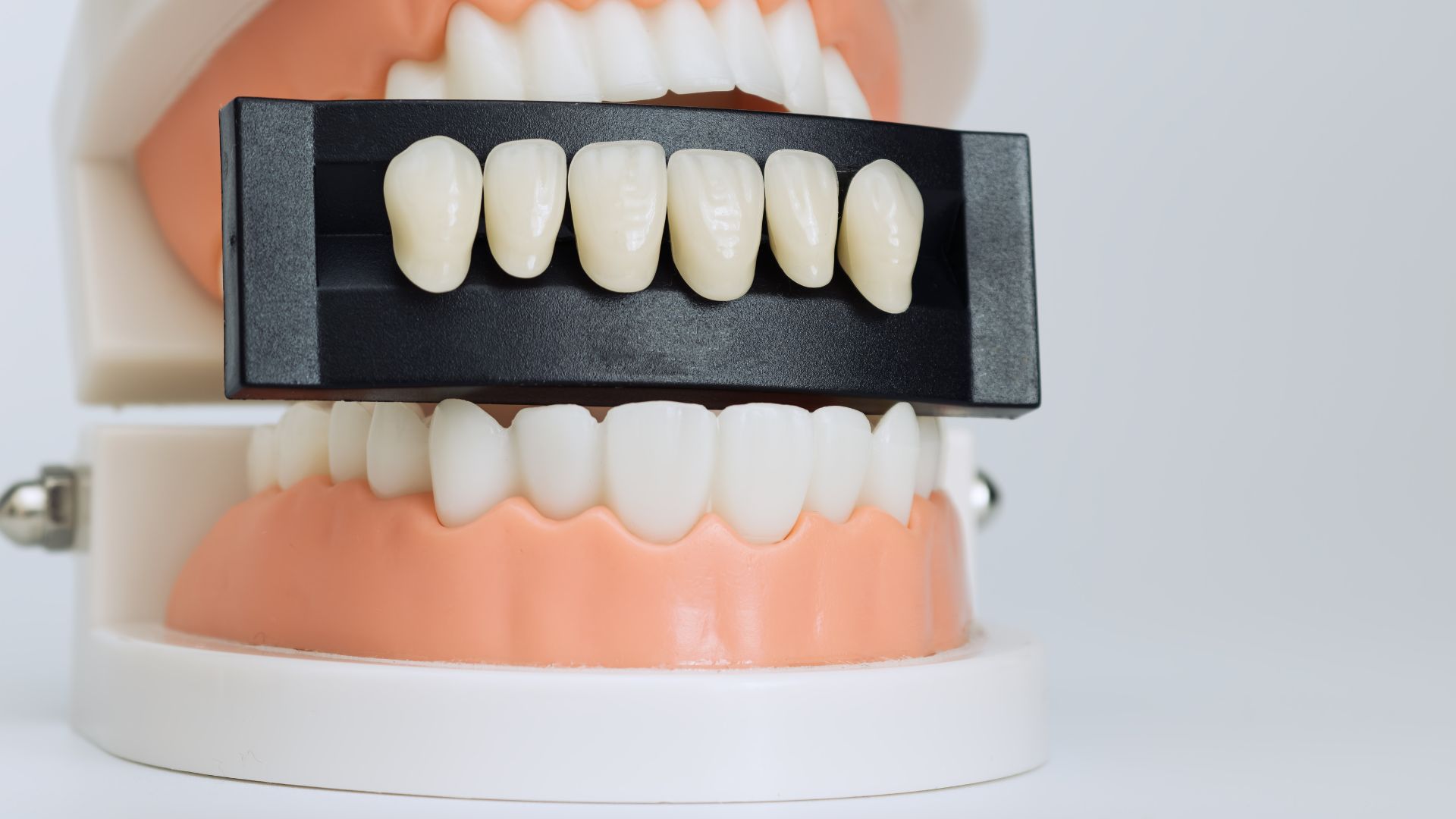 Porcelain Veneers vs. Composite Bonding: Which is Right for Your Smile Makeover?