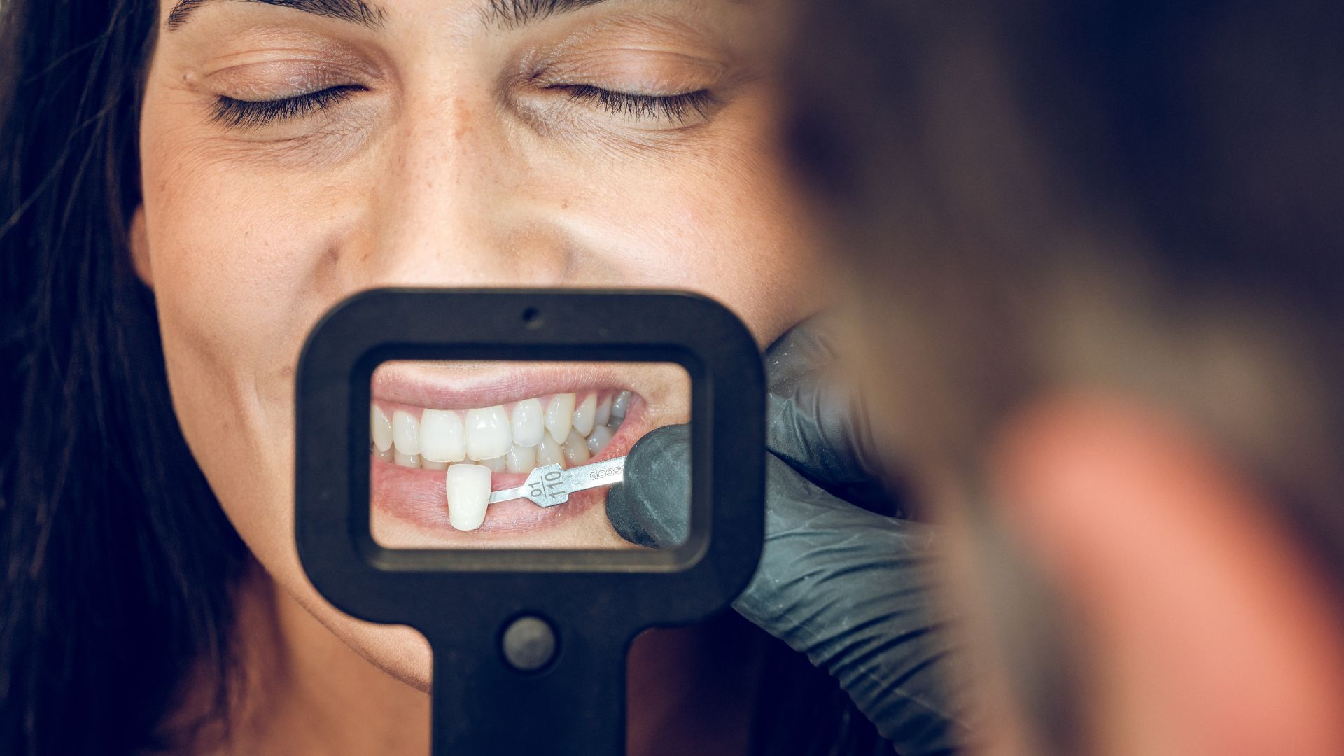 Veneers vs. Bonding – Key Differences