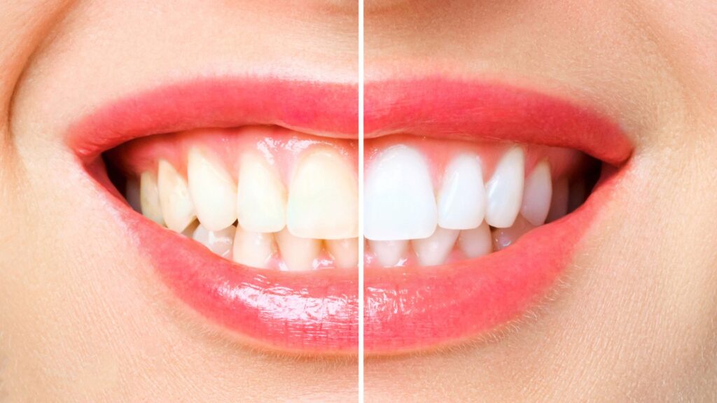 Teeth Whitening Options Explained